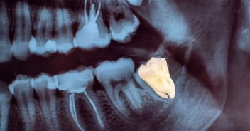 extraccion muela del juicio