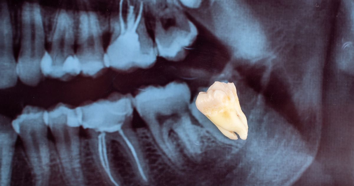 Cirugía de tercer molar: cuándo y por qué extraer las muelas del juicio