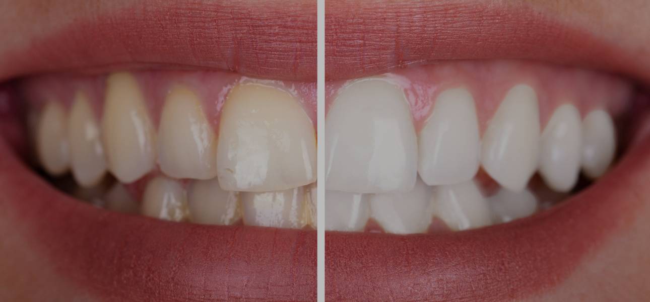 ¿Qué es el blanqueamiento dental?