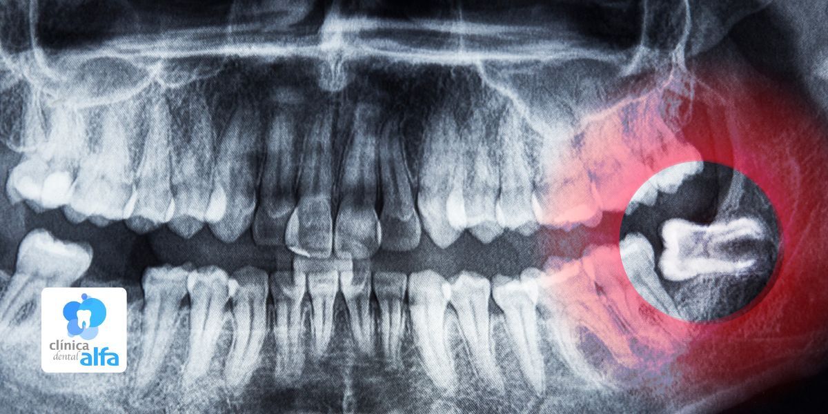Por qué sacarte las muelas del juicio en Clínica Dental Alfa