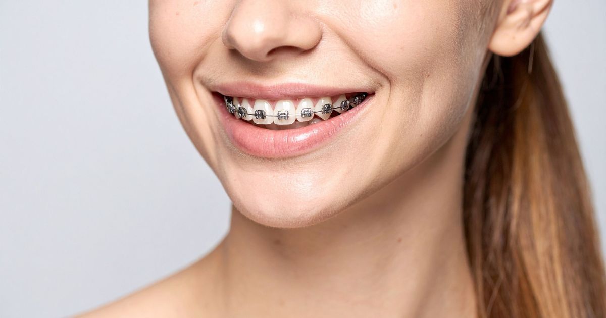 Ortodoncia tradicional: cuándo elegir brackets en lugar de alineadores invisibles
